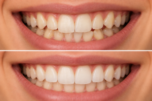 A more crowded, misaligned smile before clear aligner treatment and a straighter, more evenly aligned smile after treatment.